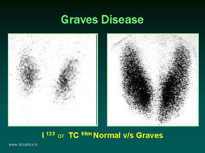 Graves Disease I 123 or TC 99 m Normal v/s Graves www. drsarma. in Graves Disease I 123 or TC 99 m Normal v/s Graves www. drsarma. in