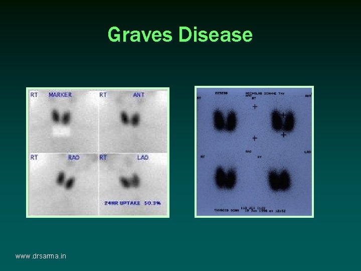 Graves Disease www. drsarma. in Graves Disease www. drsarma. in