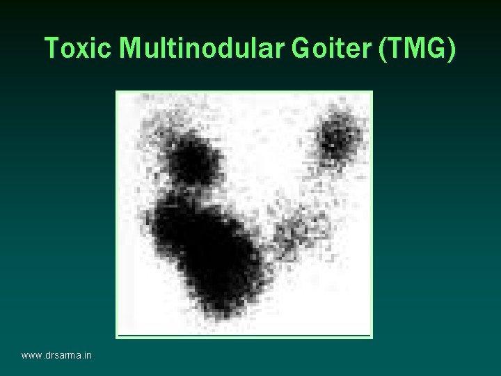 Toxic Multinodular Goiter (TMG) www. drsarma. in Toxic Multinodular Goiter (TMG) www. drsarma. in