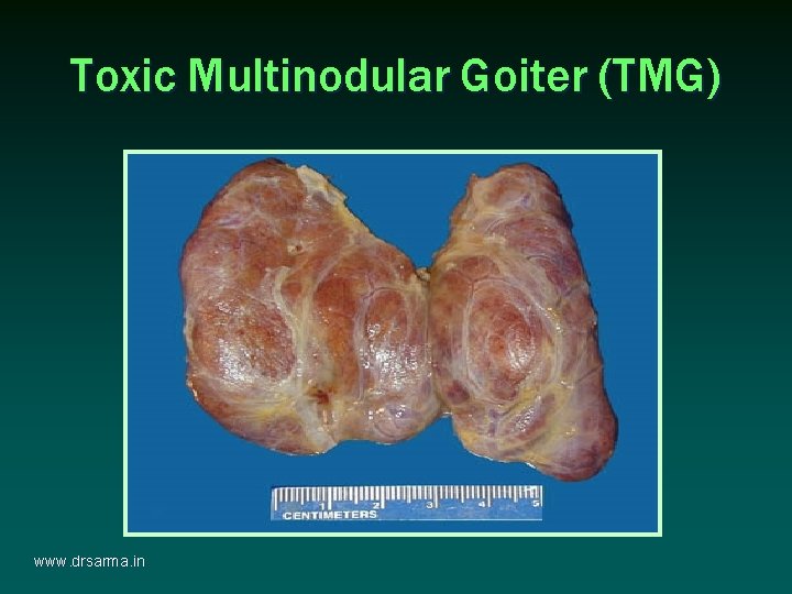 Toxic Multinodular Goiter (TMG) www. drsarma. in Toxic Multinodular Goiter (TMG) www. drsarma. in