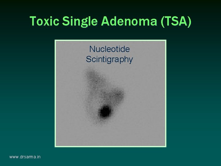 Toxic Single Adenoma (TSA) Nucleotide Scintigraphy www. drsarma. in Toxic Single Adenoma (TSA) Nucleotide Scintigraphy www. drsarma. in