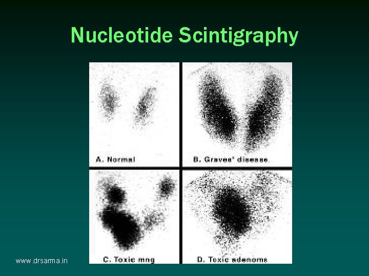 Nucleotide Scintigraphy www. drsarma. in Nucleotide Scintigraphy www. drsarma. in