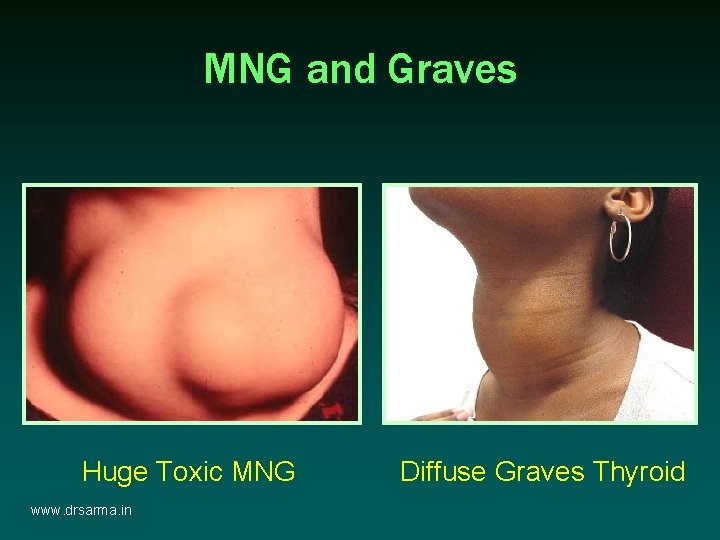 MNG and Graves Huge Toxic MNG www. drsarma. in Diffuse Graves Thyroid MNG and Graves Huge Toxic MNG www. drsarma. in Diffuse Graves Thyroid