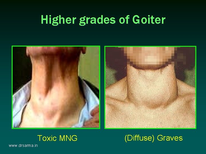Higher grades of Goiter Toxic MNG www. drsarma. in (Diffuse) Graves Higher grades of Goiter Toxic MNG www. drsarma. in (Diffuse) Graves