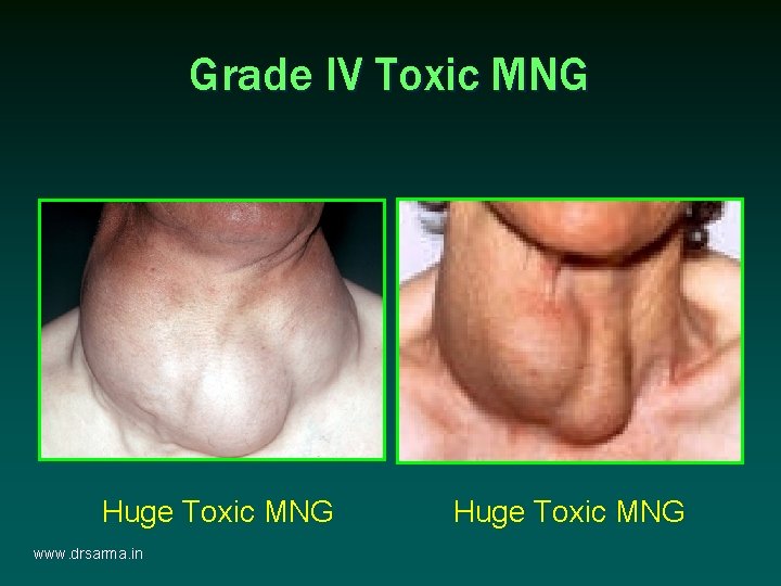 Grade IV Toxic MNG Huge Toxic MNG www. drsarma. in Huge Toxic MNG Grade IV Toxic MNG Huge Toxic MNG www. drsarma. in Huge Toxic MNG