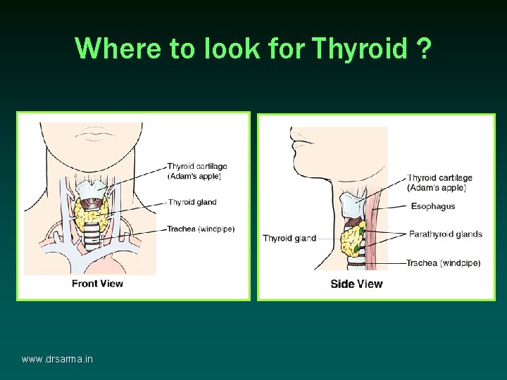 Where to look for Thyroid ? www. drsarma. in Where to look for Thyroid ? www. drsarma. in