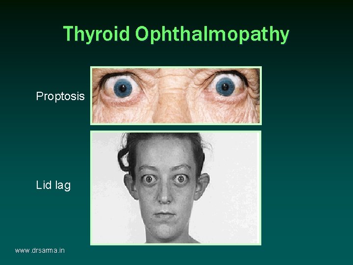 Thyroid Ophthalmopathy Proptosis Lid lag www. drsarma. in Thyroid Ophthalmopathy Proptosis Lid lag www. drsarma. in