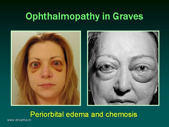 Ophthalmopathy in Graves Periorbital edema and chemosis www. drsarma. in Ophthalmopathy in Graves Periorbital edema and chemosis www. drsarma. in