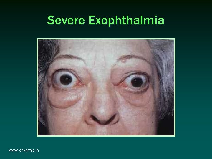 Severe Exophthalmia www. drsarma. in Severe Exophthalmia www. drsarma. in