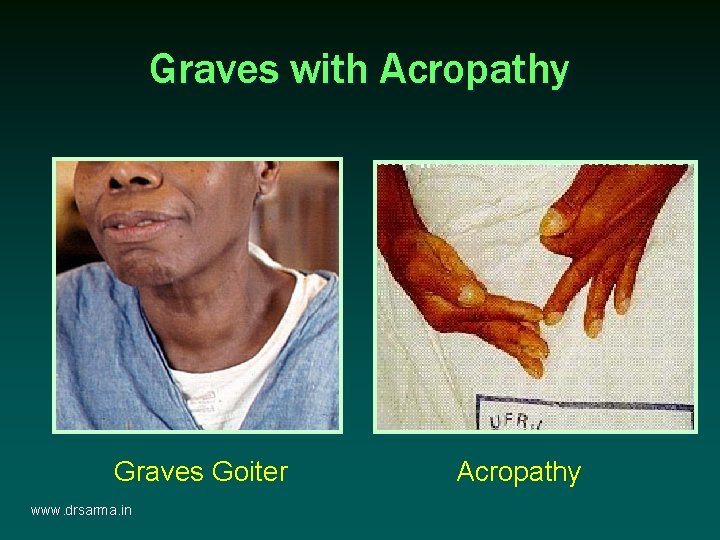 Graves with Acropathy Graves Goiter www. drsarma. in Acropathy Graves with Acropathy Graves Goiter www. drsarma. in Acropathy