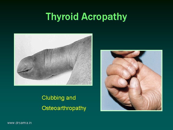 Thyroid Acropathy Clubbing and Osteoarthropathy www. drsarma. in Thyroid Acropathy Clubbing and Osteoarthropathy www. drsarma. in