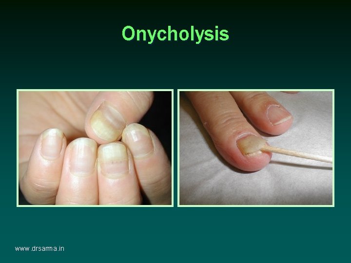 Onycholysis www. drsarma. in Onycholysis www. drsarma. in