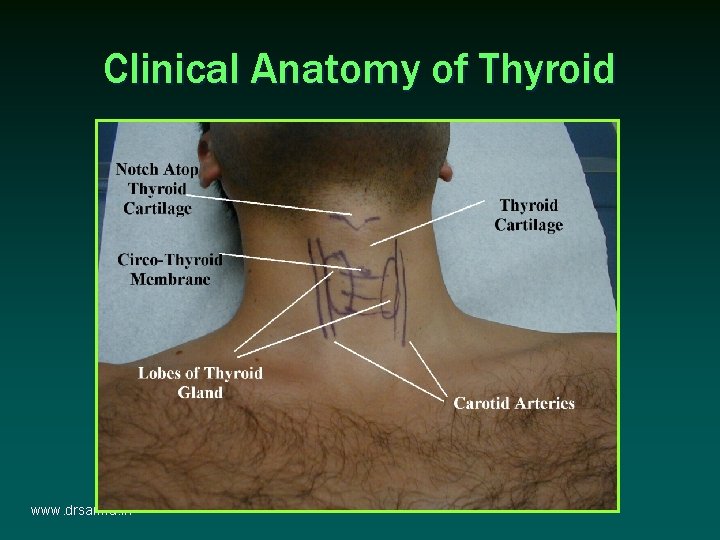 Clinical Anatomy of Thyroid www. drsarma. in Clinical Anatomy of Thyroid www. drsarma. in
