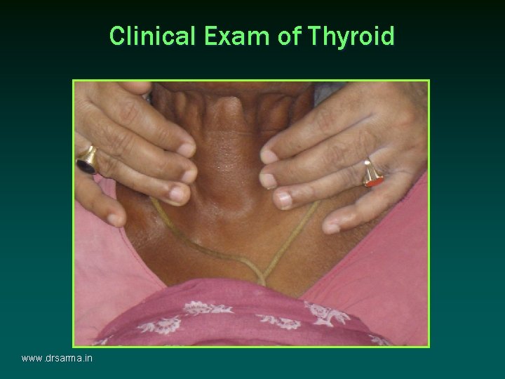 Clinical Exam of Thyroid www. drsarma. in Clinical Exam of Thyroid www. drsarma. in