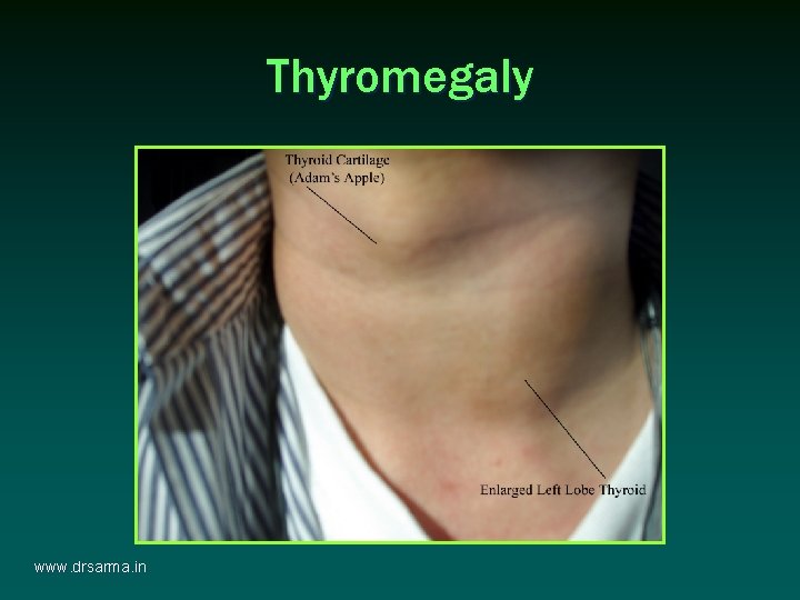 Thyromegaly www. drsarma. in Thyromegaly www. drsarma. in