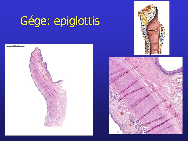 Gége: epiglottis 