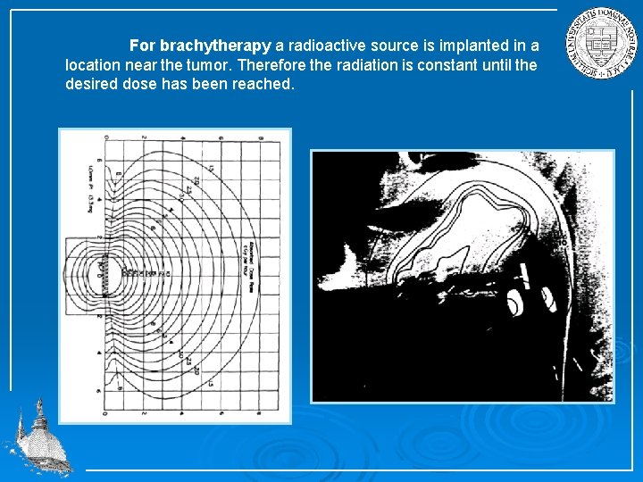 For brachytherapy a radioactive source is implanted in a location near the tumor. Therefore