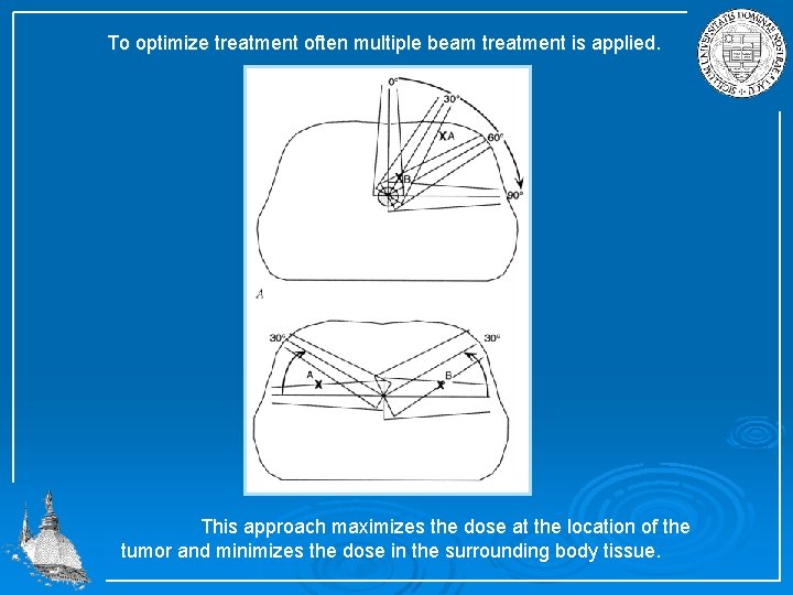 To optimize treatment often multiple beam treatment is applied. This approach maximizes the dose