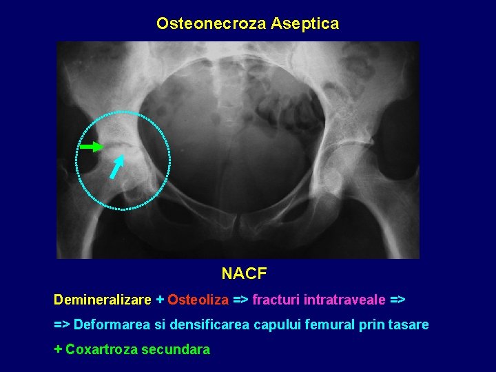 Osteonecroza Aseptica NACF Demineralizare + Osteoliza => fracturi intratraveale => => Deformarea si densificarea