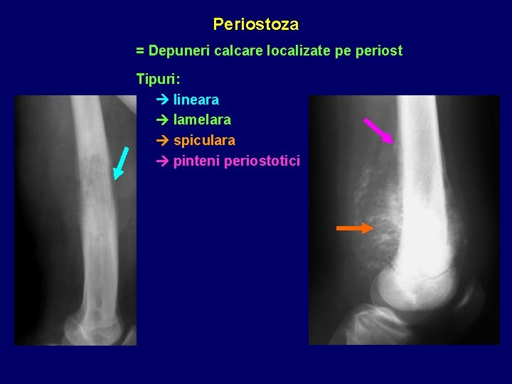 Periostoza = Depuneri calcare localizate pe periost Tipuri: lineara lamelara spiculara pinteni periostotici 