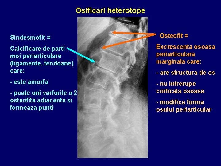 Osificari heterotope Sindesmofit = Osteofit = Calcificare de parti moi periarticulare (ligamente, tendoane) care: