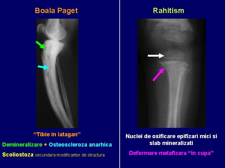 Boala Paget “Tibie in iatagan” Demineralizare + Osteoscleroza anarhica Scoliostoza secundara modificarilor de structura