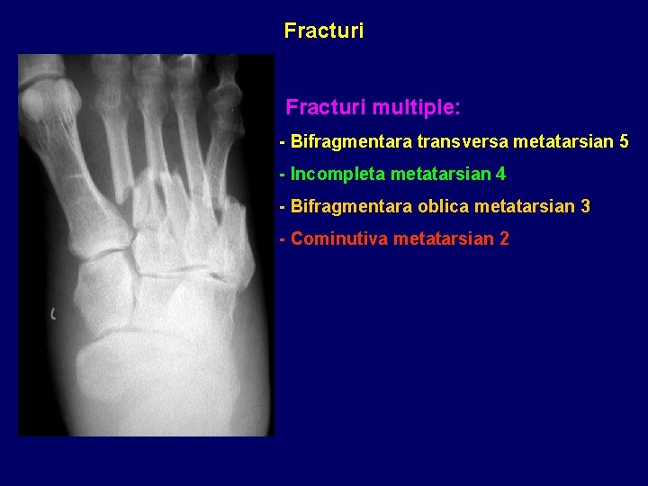 Fracturi multiple: - Bifragmentara transversa metatarsian 5 - Incompleta metatarsian 4 - Bifragmentara oblica