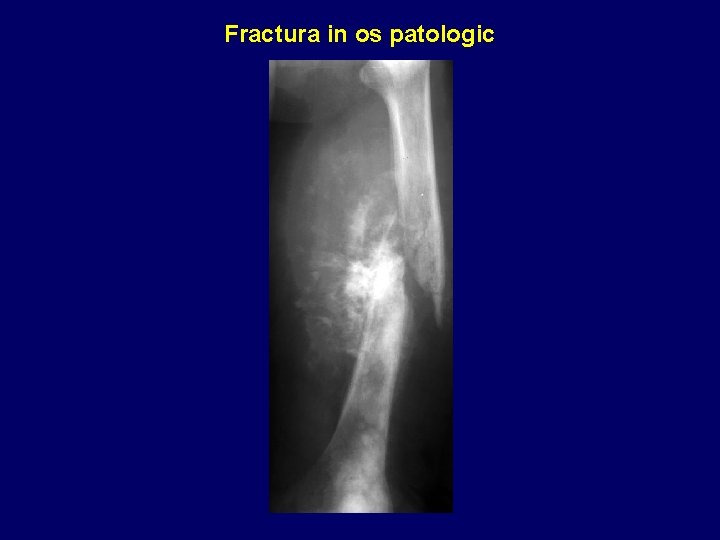 Fractura in os patologic 