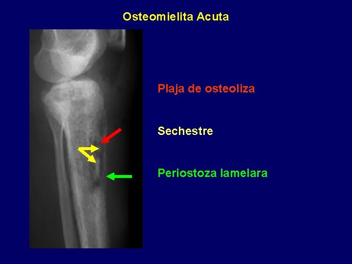 Osteomielita Acuta Plaja de osteoliza Sechestre Periostoza lamelara 