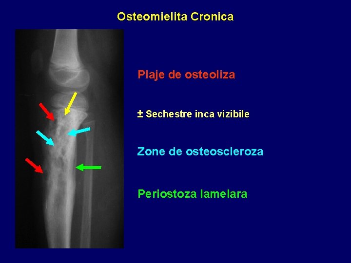 Osteomielita Cronica Plaje de osteoliza ± Sechestre inca vizibile Zone de osteoscleroza Periostoza lamelara