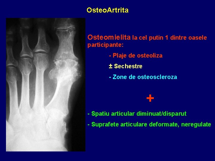 Osteo. Artrita Osteomielita la cel putin 1 dintre oasele participante: - Plaje de osteoliza