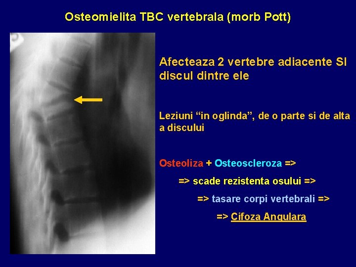 Osteomielita TBC vertebrala (morb Pott) Afecteaza 2 vertebre adiacente SI discul dintre ele Leziuni