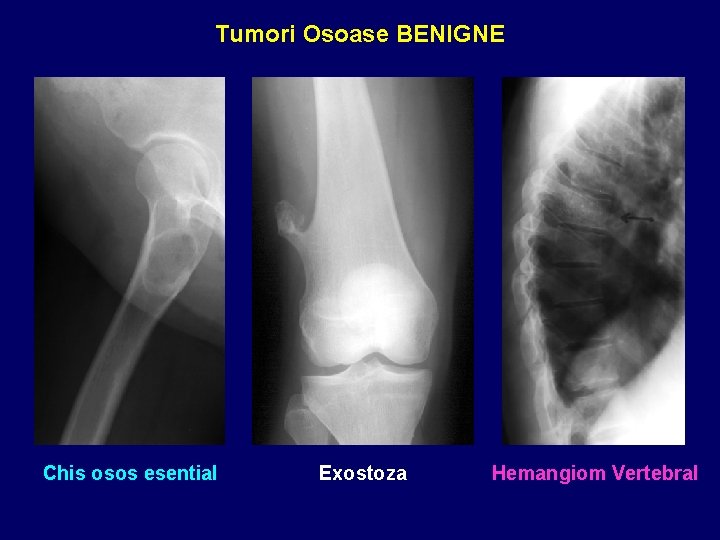 Tumori Osoase BENIGNE Osteocondrom Chis osos esential Exostoza Hemangiom Vertebral 