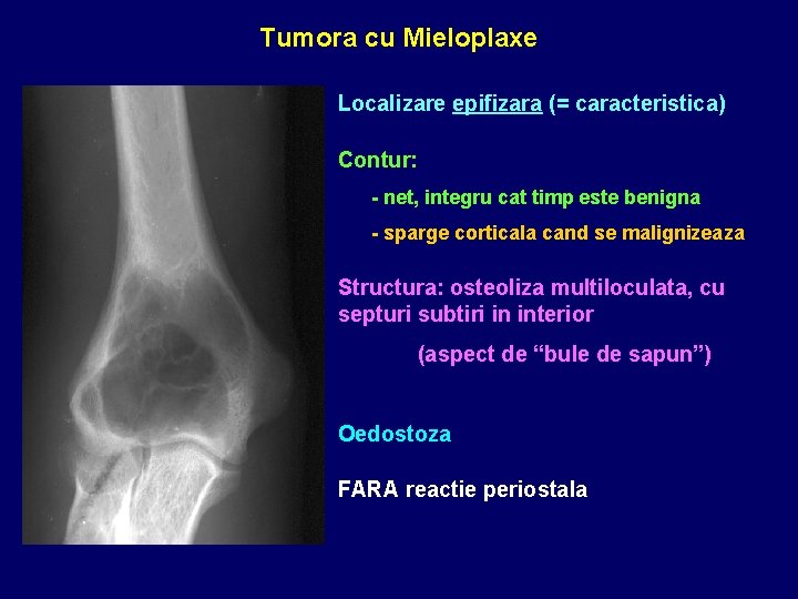 Tumora cu Mieloplaxe Localizare epifizara (= caracteristica) Contur: - net, integru cat timp este