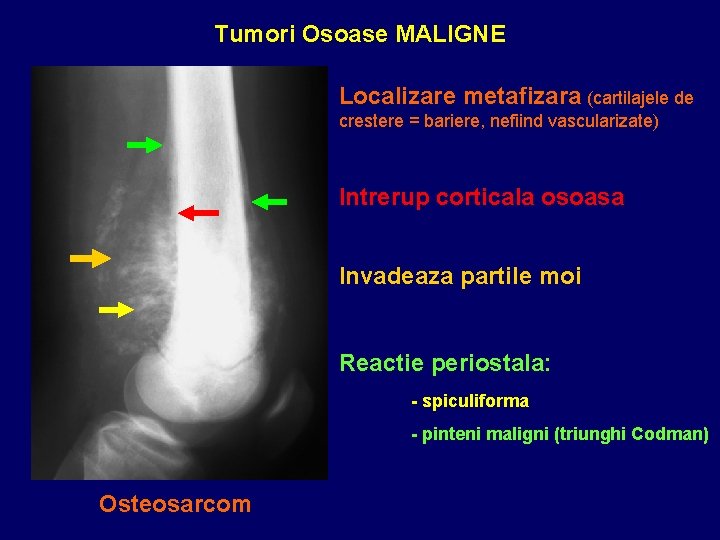 Tumori Osoase MALIGNE Localizare metafizara (cartilajele de crestere = bariere, nefiind vascularizate) Intrerup corticala