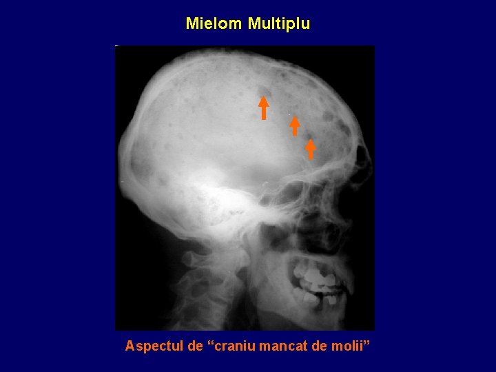 Mielom Multiplu Aspectul de “craniu mancat de molii” 