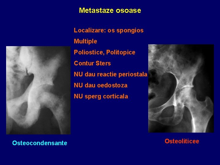 Metastaze osoase Localizare: os spongios Multiple Poliostice, Politopice Contur Sters NU dau reactie periostala