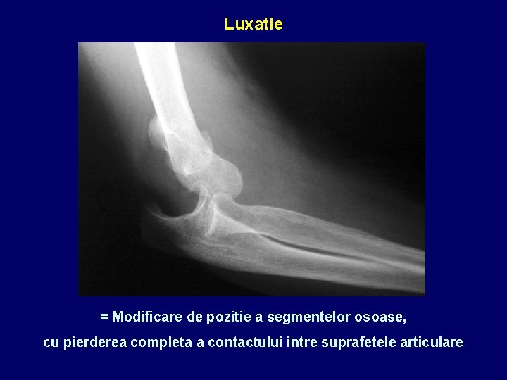 Luxatie = Modificare de pozitie a segmentelor osoase, cu pierderea completa a contactului intre