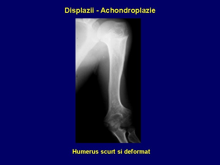Displazii - Achondroplazie Humerus scurt si deformat 