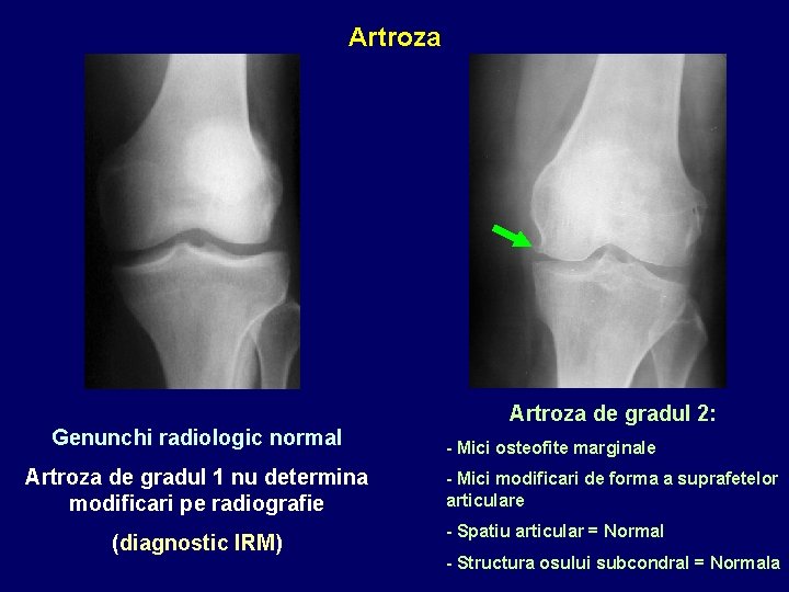 Artroza de gradul 2: Genunchi radiologic normal Artroza de gradul 1 nu determina modificari