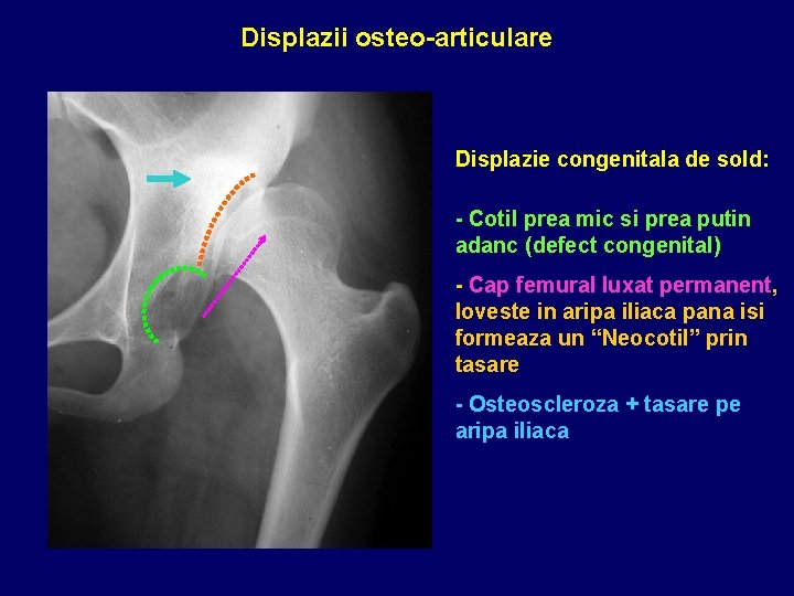 Displazii osteo-articulare Displazie congenitala de sold: - Cotil prea mic si prea putin adanc