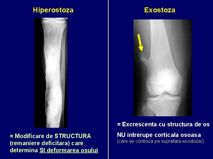 Hiperostoza Exostoza = Excrescenta cu structura de os = Modificare de STRUCTURA (remaniere deficitara)
