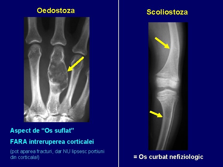 Oedostoza Scoliostoza Aspect de “Os suflat” FARA intreruperea corticalei (pot aparea fracturi, dar NU