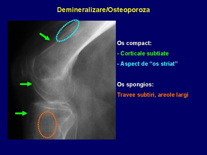 Demineralizare/Osteoporoza Os compact: - Corticale subtiate - Aspect de “os striat” Os spongios: Travee