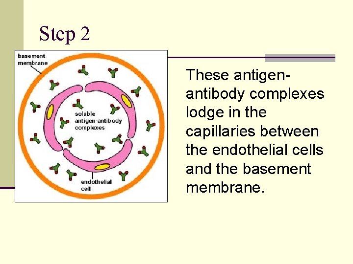 Step 2 These antigenantibody complexes lodge in the capillaries between the endothelial cells and