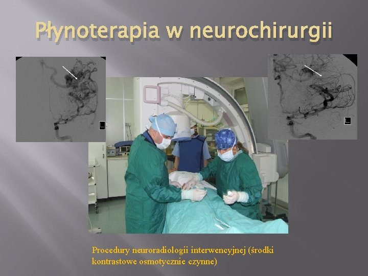 Płynoterapia w neurochirurgii Procedury neuroradiologii interwencyjnej (środki kontrastowe osmotycznie czynne) 