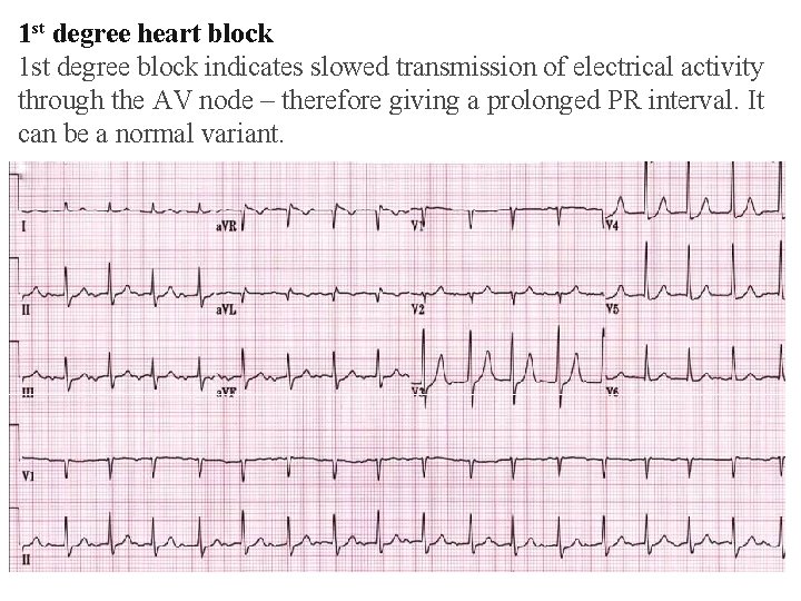 1 st degree heart block 1 st degree block indicates slowed transmission of electrical 1 st degree heart block 1 st degree block indicates slowed transmission of electrical