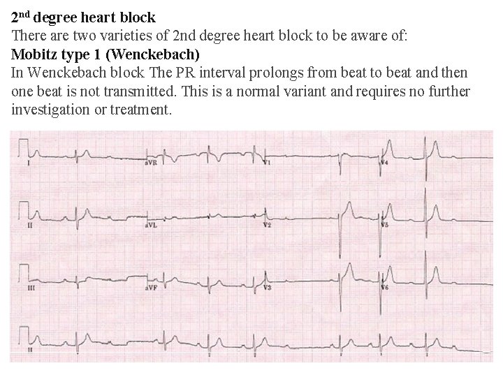 2 nd degree heart block There are two varieties of 2 nd degree heart 2 nd degree heart block There are two varieties of 2 nd degree heart