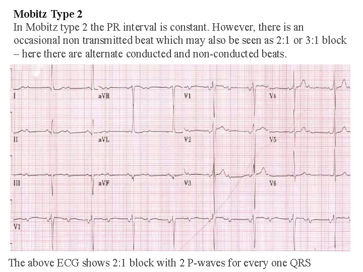 Mobitz Type 2 In Mobitz type 2 the PR interval is constant. However, there Mobitz Type 2 In Mobitz type 2 the PR interval is constant. However, there