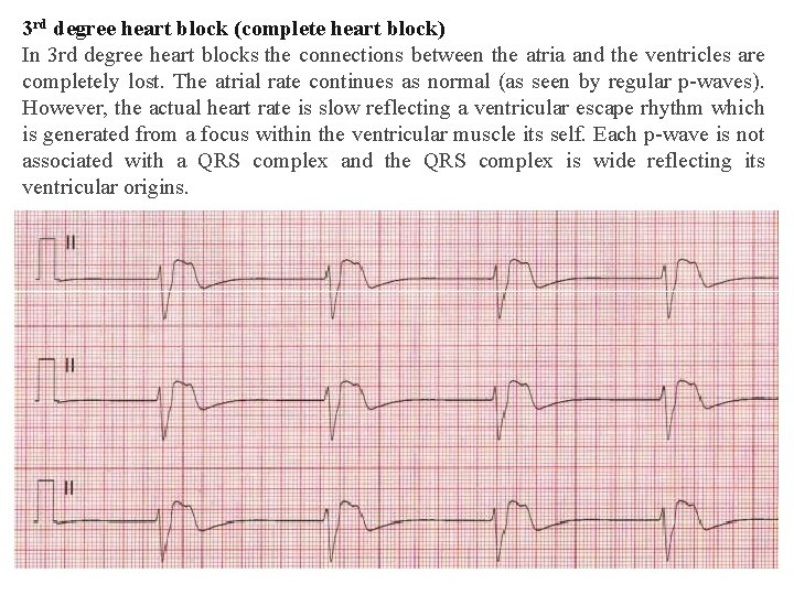 3 rd degree heart block (complete heart block) In 3 rd degree heart blocks 3 rd degree heart block (complete heart block) In 3 rd degree heart blocks